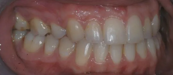 top and bottom view of teeth 