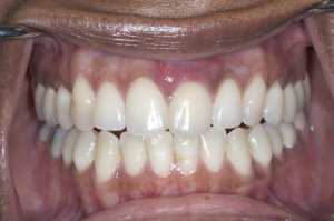 dental implant tooth - full mouth view