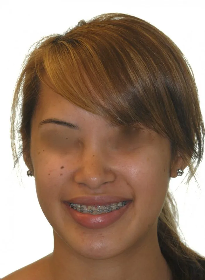 Smiling girl with braces