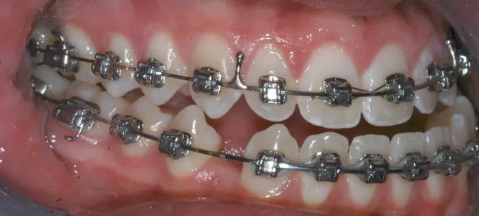 teeth with braces top and bottom 