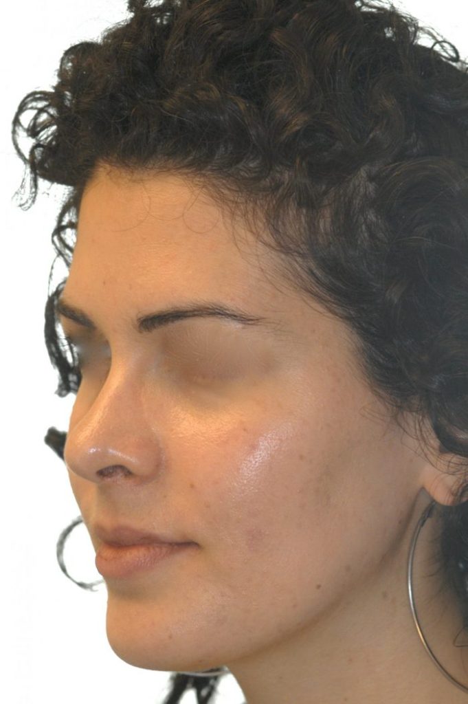 woman's side left jawline view 