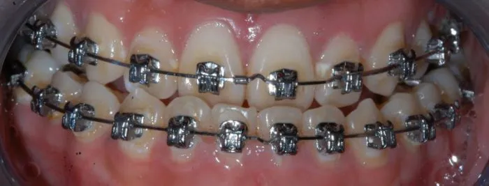 smiling view of upper and lower teeth with braces