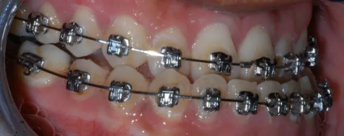smiling view of upper and lower teeth with braces