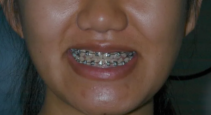 Smiling girl with braces - half of the face