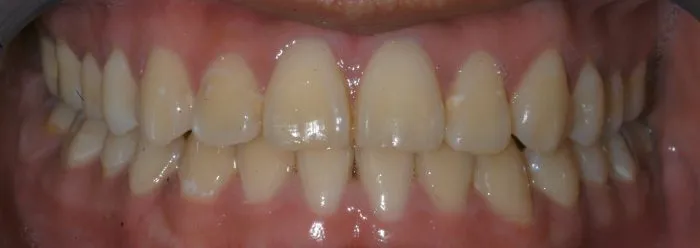 picture of teeth upper and lower
