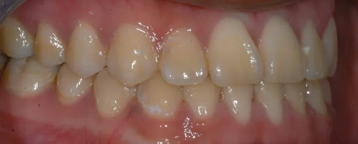 picture of teeth upper and lower