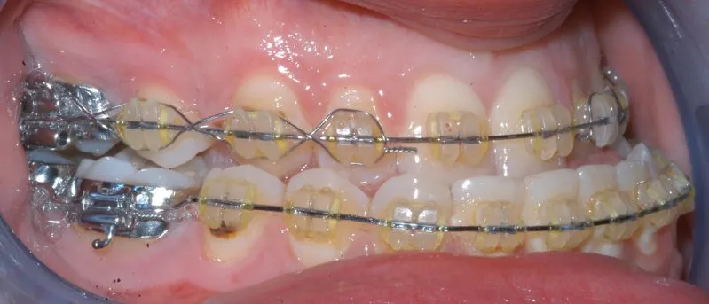 teeth with braces top and bottom - showing not aligned   