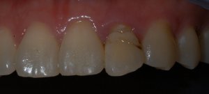 dental implant tooth before 
