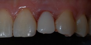dental implant tooth after