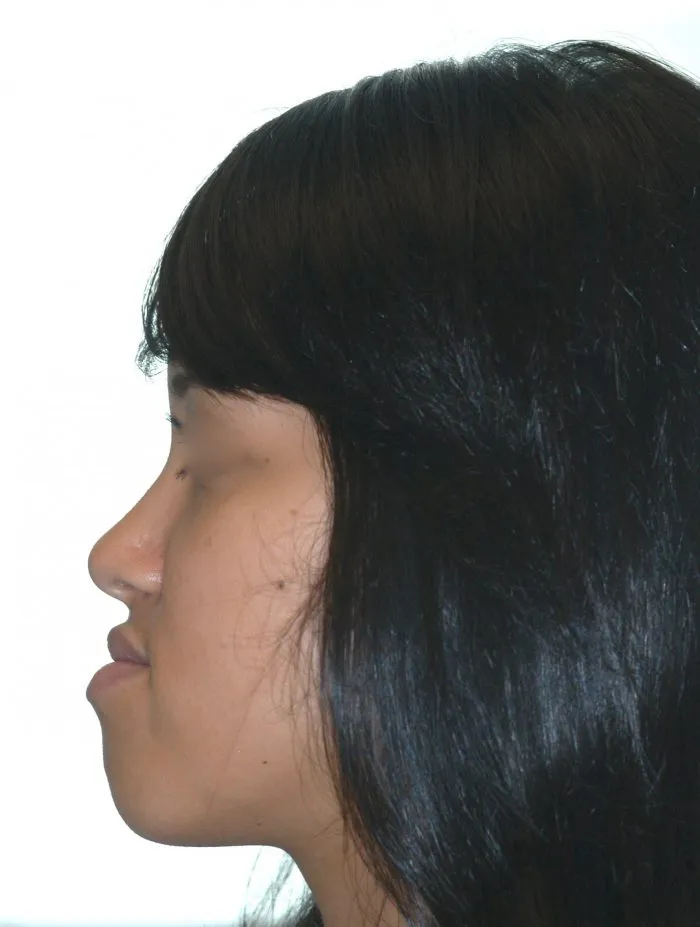 side view of young girl - facial contouring