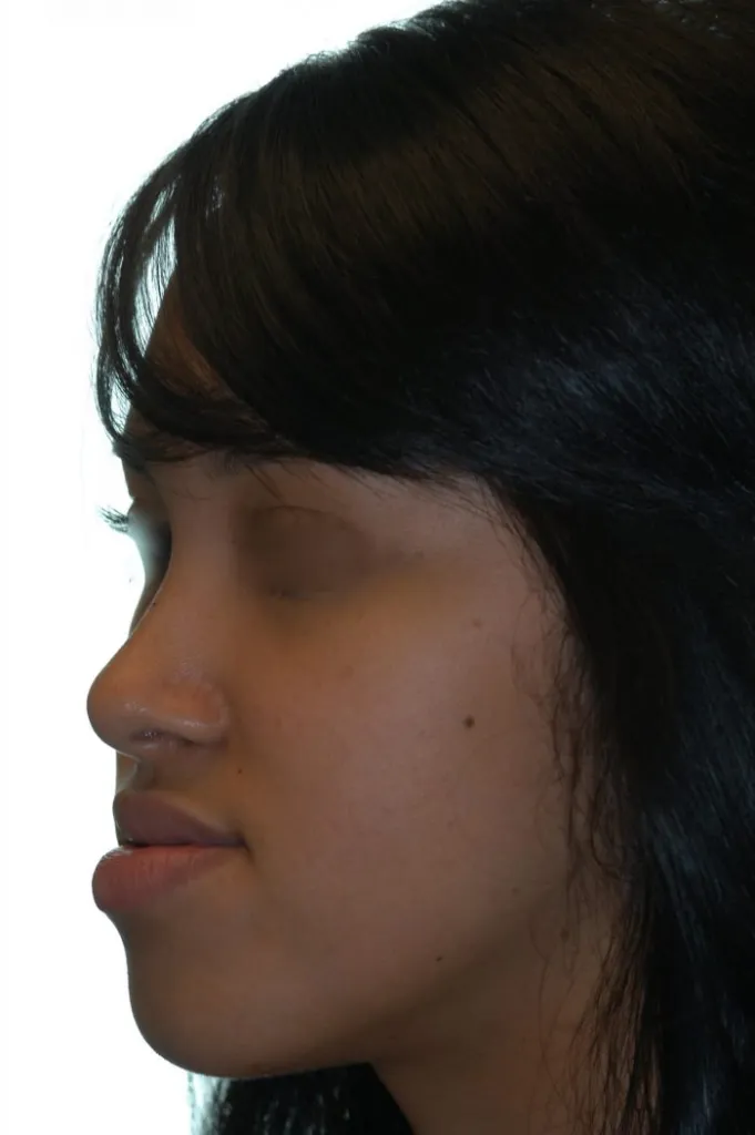 side of young girl left side - facial contouring 