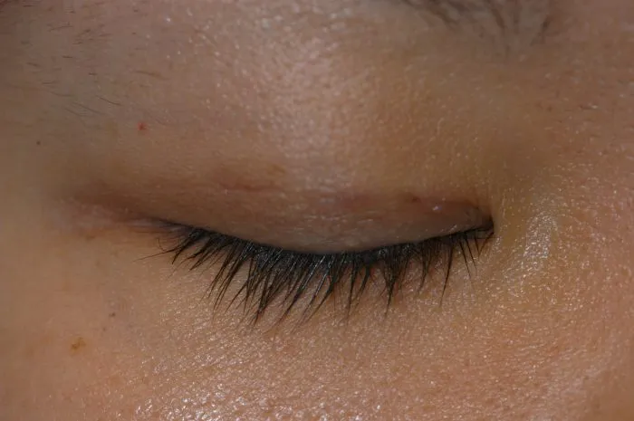 eye lid closed