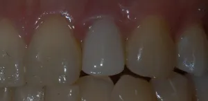 dental implant tooth- after 