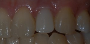 dental implant tooth- after