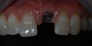 missing tooth prep for dental implant tooth