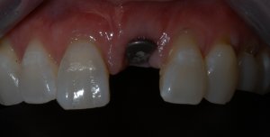 missing tooth prep for dental implant tooth 