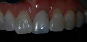 dental implant front tooth 