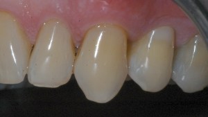 dental implant example