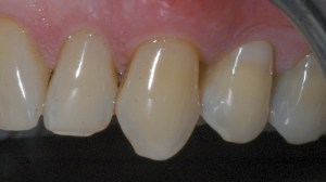 dental implant example