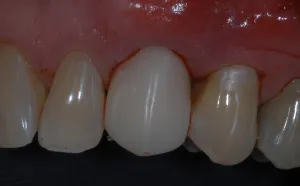 dental implant example on one tooth