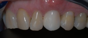 top closeup picture of teeth - dental implant example
