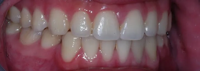 picture of teeth - top and bottom