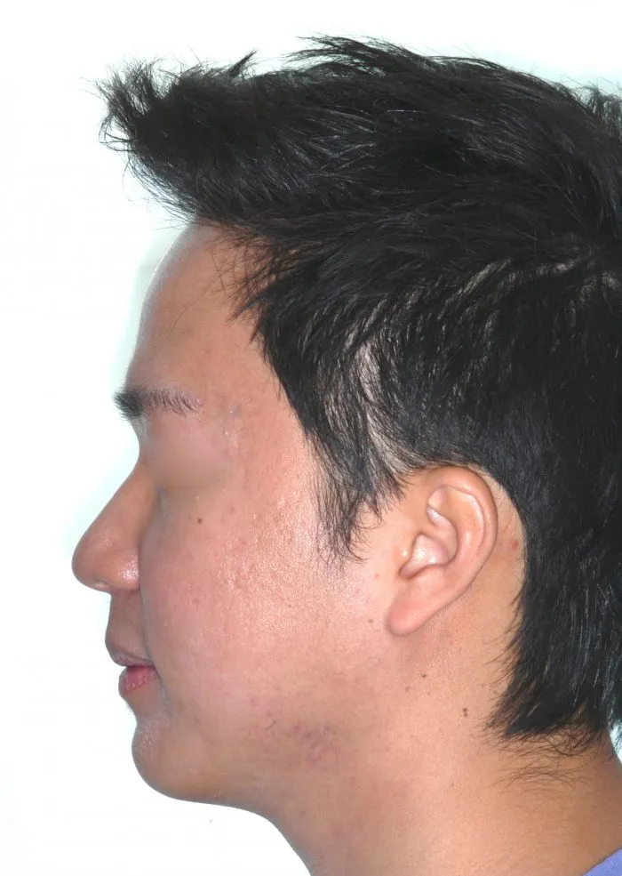 side view of man- left jaw