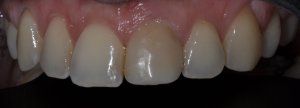 top tooth of dental implant -before