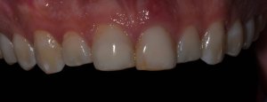 before dental implant tooth