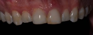before dental implant tooth 