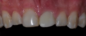 before dental implant tooth -close up