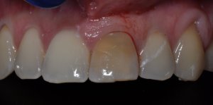 dental implant front tooth -before