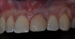 dental implant front tooth -after