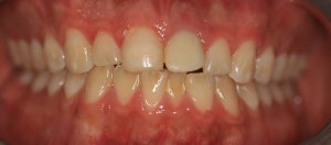 before dental implant tooth