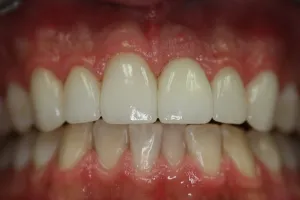 after dental implant tooth on upper teeth