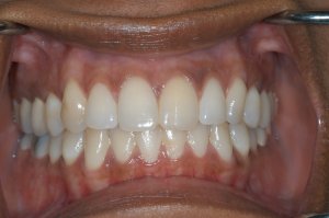dental implant tooth - full mouth view