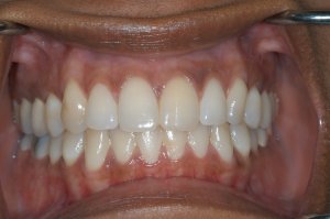 dental implant tooth - full mouth view 