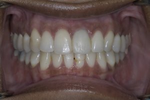 dental implant tooth full mouth view