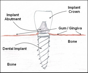 Diagram of a dental implant in the jaw bone and when bone grafting may be needed used by Irvine oral surgeon